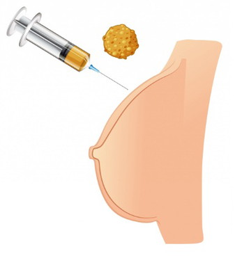 Bild zur Brustvergrößerung mit Eigenfett